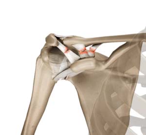 AC Joint Injuries