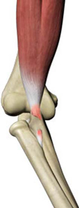 Biceps Tendon Injuries