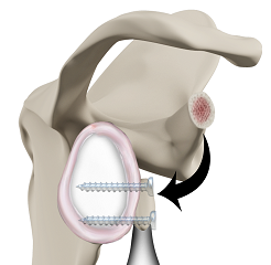 Latarjet Procedure