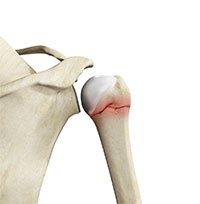 Shoulder Fractures