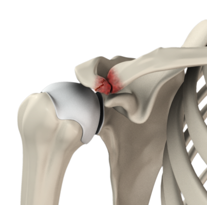 AC Joint Injuries