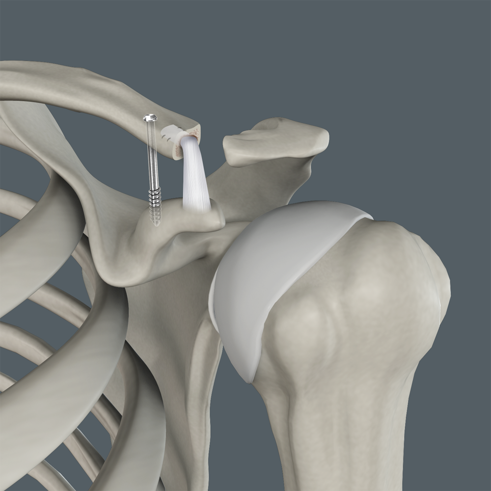 AC Joint Reconstruction