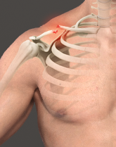 Clavicle Fracture Repair