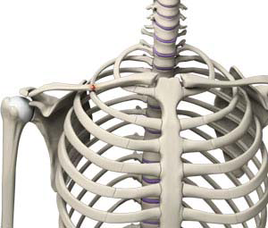 Collarbone Fractures