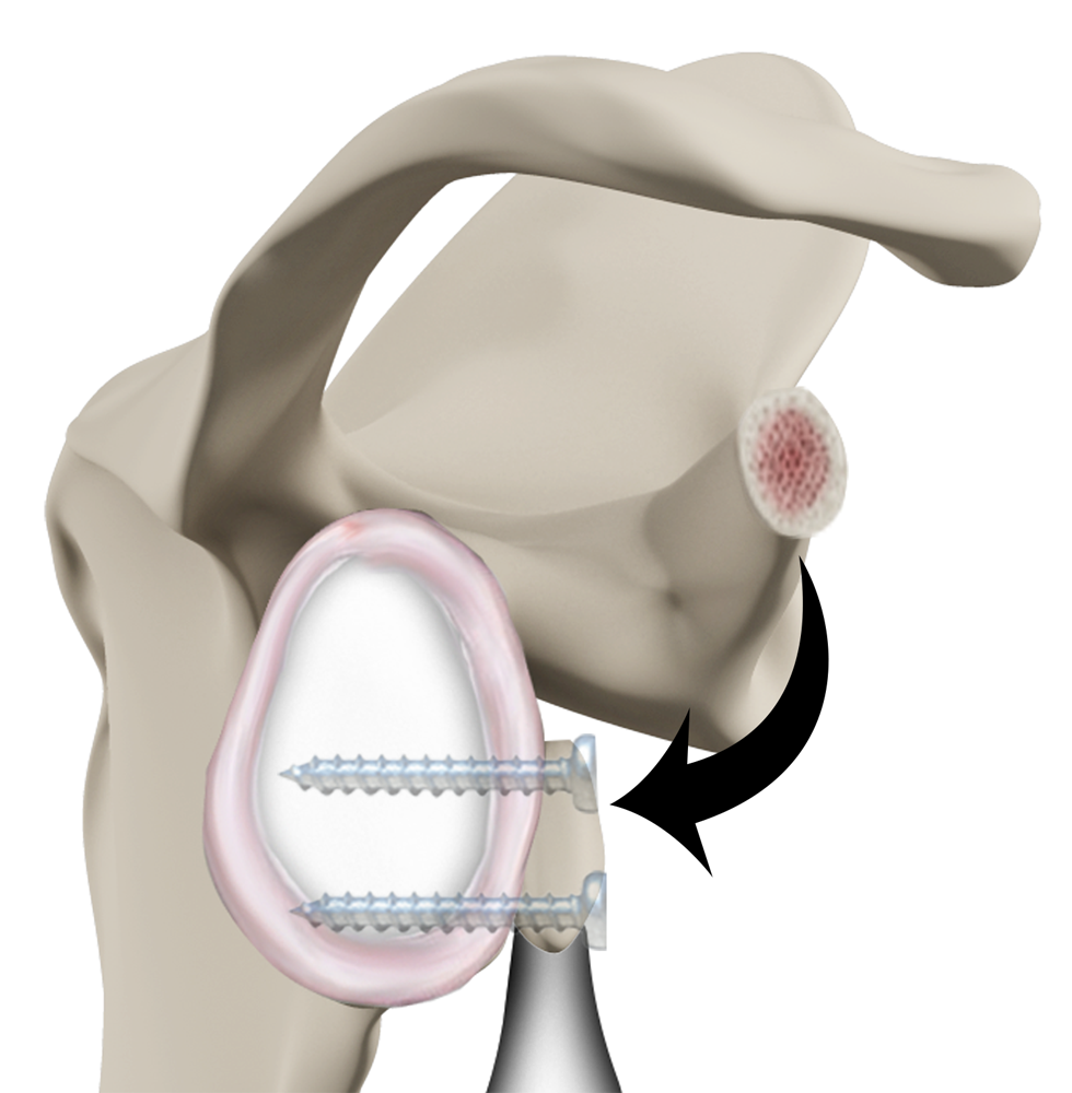 Latarjet Procedure