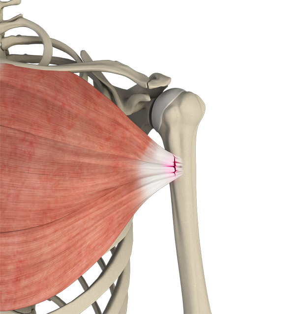 Pectoralis Major Ruptures