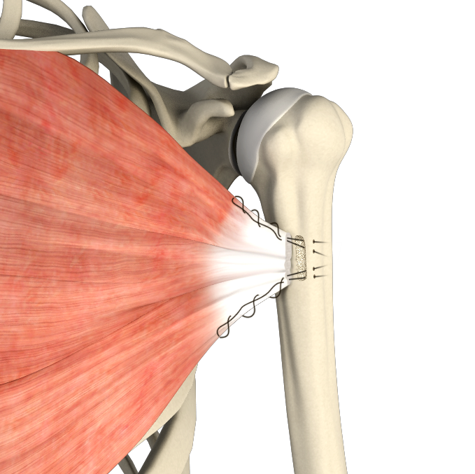 Pectoralis Major Repair