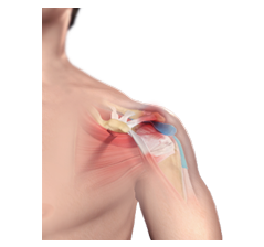 Shoulder Pain