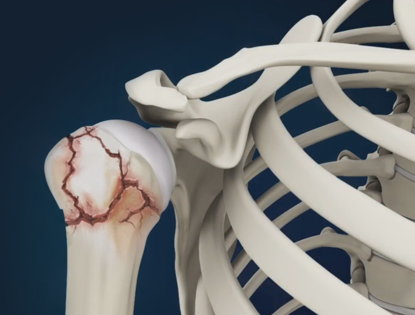 Shoulder Fracture Repair